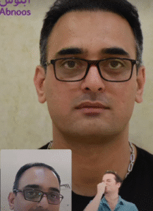 نمونه کاشت مو کلینیک زیبایی آبنوس