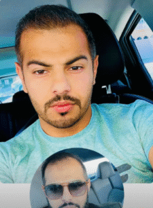 نمونه کاشت مو کلینیک زیبایی آبنوس