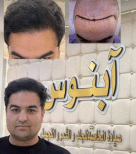 نمونه کاشت مو کلینیک زیبایی آبنوس