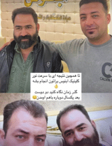 نمونه کاشت مو کلینیک زیبایی آبنوس