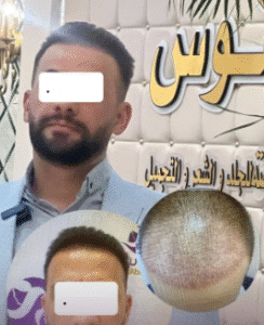 نمونه کاشت مو کلینیک زیبایی آبنوس