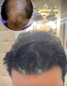 نمونه کاشت مو کلینیک زیبایی آبنوس