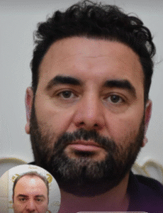 نمونه کاشت مو کلینیک زیبایی آبنوس