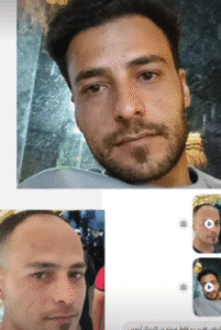 نمونه کاشت مو کلینیک زیبایی آبنوس