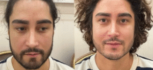 نمونه کاشت مو کلینیک زیبایی آبنوس