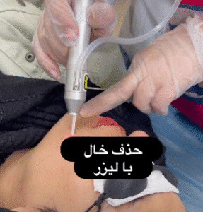 نمونه لیزر فرکشنال دکتر سارا ملکارا