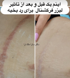 نمونه لیزر فرکشنال دکتر سارا ملکارا
