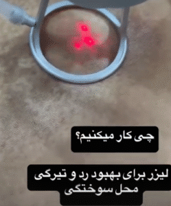 نمونه لیزر فرکشنال دکتر سارا ملکارا