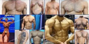 نمونه عمل ژنیکوماستی دکتر محمد حدادی اول