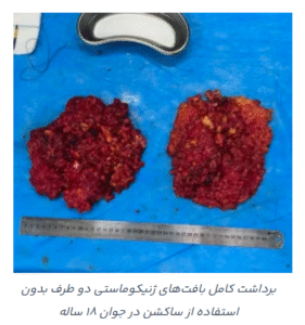 نمونه عمل ژنیکوماستی دکتر محمد حدادی اول