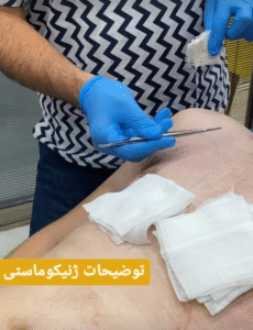 نمونه ژنیکوماستی دکتر حسن طالب زاده