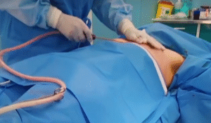 نمونه ژنیکوماستی دکتر حسن طالب زاده