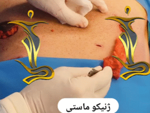 نمونه ژنیکوماستی دکتر حسن طالب زاده