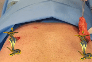 نمونه ژنیکوماستی دکتر حسن طالب زاده