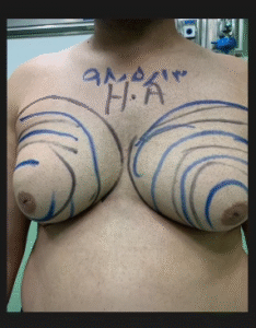 نمونه ژنیکوماستی دکتر جلال احمدی