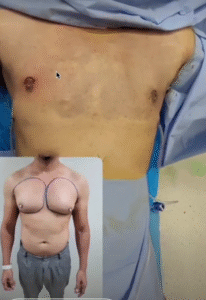 نمونه ژنیکوماستی دکتر جلال احمدی