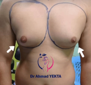 نمونه ژنیکوماستی دکتر احمد یکتا