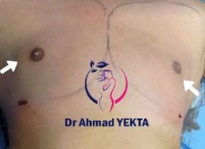 نمونه ژنیکوماستی دکتر احمد یکتا