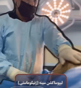 نمونه ژنیکوماستی دکتر احمد یکتا