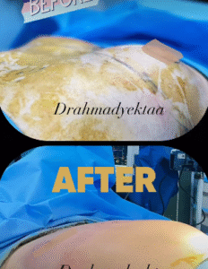 نمونه ژنیکوماستی دکتر احمد یکتا