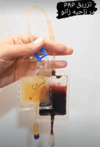 نمونه تزریق مفصل دکتر رضا عرفانی سیار