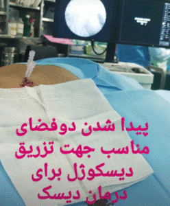 نمونه تزریق دیسکوژل دکتر رضا عرفانی سیار