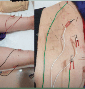 نمونه طب سوزنی دکتر رضا عرفانی سیار