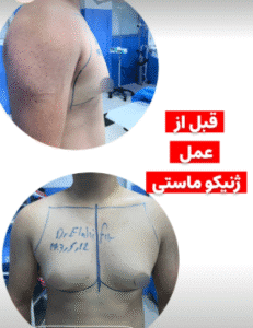 نمونه ژنیکوماستی دکتر کاظم الهی فر