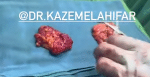 نمونه ژنیکوماستی دکتر کاظم الهی فر