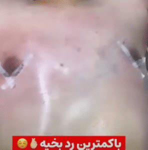 نمونه ژنیکوماستی دکتر کاظم الهی فر