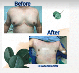 نمونه ژنیکوماستی دکتر کاظم الهی فر