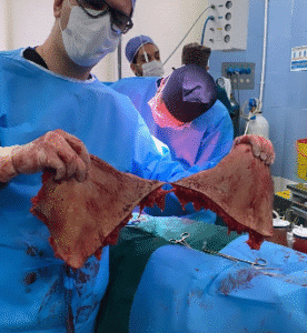 نمونه ابدومینوپلاستی دکتر جلال معتمدی فر