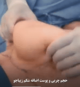 نمونه ابدومینوپلاستی دکتر جلال معتمدی فر