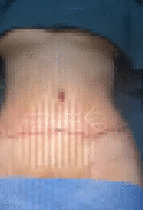 نمونه ابدومینوپلاستی دکتر جلال معتمدی فر