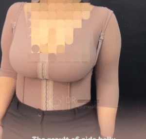 نمونه ابدومینوپلاستی دکتر جلال معتمدی فر