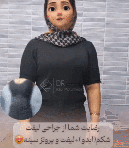 نمونه ابدومینوپلاستی دکتر جلال معتمدی فر