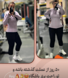 نمونه ابدومینوپلاستی دکتر جلال معتمدی فر