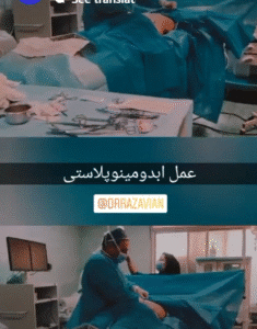 نمونه ابدومینوپلاستی دکتر حسین رضویان