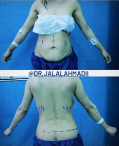 نمونه ابدومینوپلاستی دکتر جلال احمدی