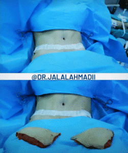 نمونه ابدومینوپلاستی دکتر جلال احمدی
