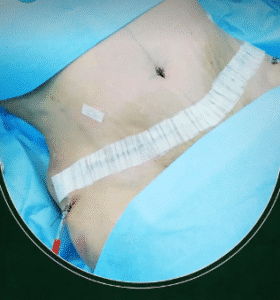 نمونه ابدومینوپلاستی دکتر جلال احمدی