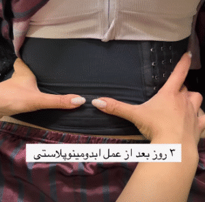 نمونه ابدومینوپلاستی دکتر کامران کاویانی فر