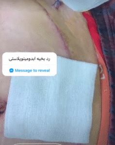 نمونه ابدومینوپلاستی دکتر کامران کاویانی فر