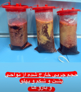 نمونه ابدومینوپلاستی دکتر کامران کاویانی فر