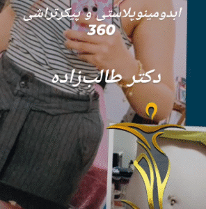 نمونه ابدومینوپلاستی دکتر حسن طالب زاده