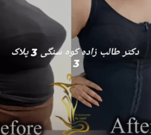 نمونه ابدومینوپلاستی دکتر حسن طالب زاده