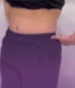 نمونه ابدومینوپلاستی دکتر حسن طالب زاده