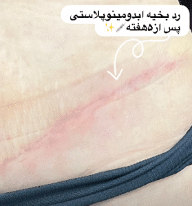 نمونه ابدومینوپلاستی دکتر حسن طالب زاده