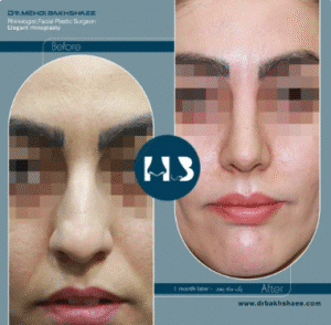 نمونه عمل بینی دکتر مهدی بخشایی