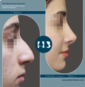 نمونه عمل بینی دکتر مهدی بخشایی